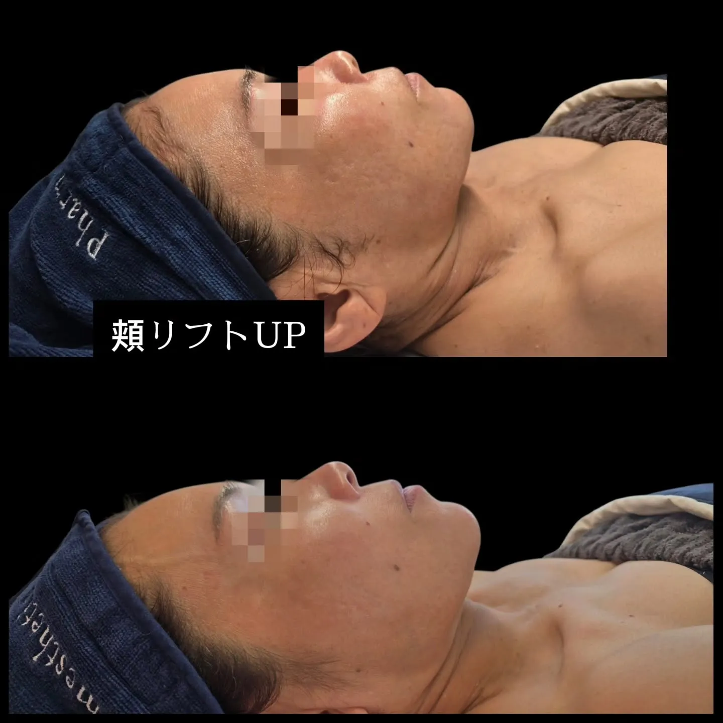 【SUPERJECTION】